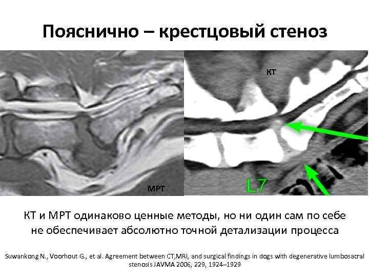 Пояснично – крестцовый стеноз КТ МРТ КТ и МРТ одинаково ценные методы, но ни