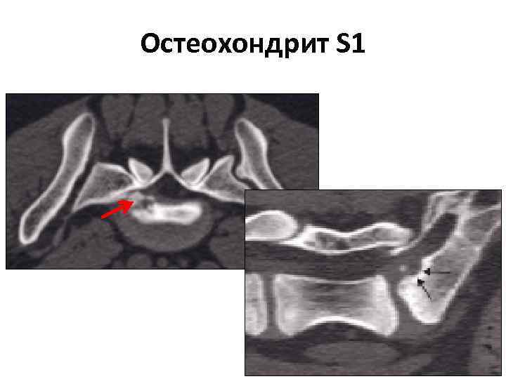 Остеохондрит S 1 