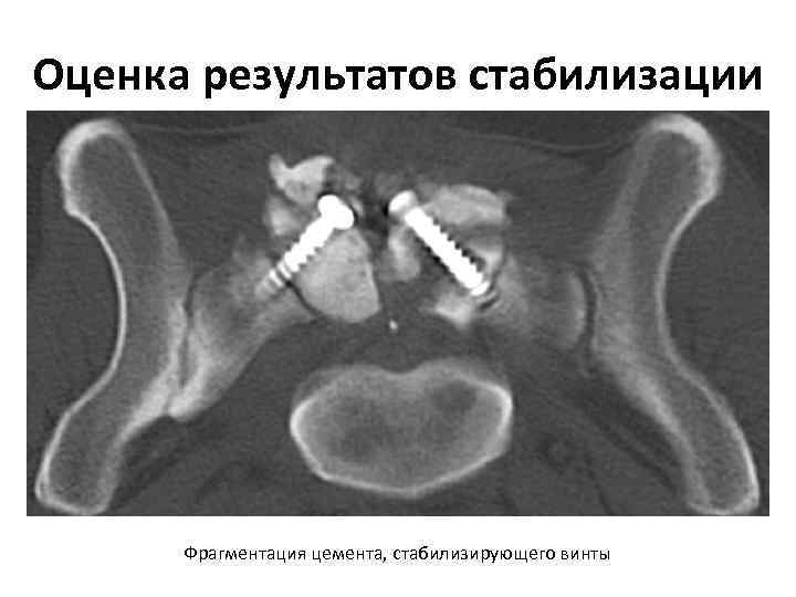 Оценка результатов стабилизации Фрагментация цемента, стабилизирующего винты 