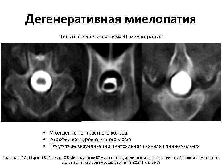 Дегенеративная миелопатия Только с использованием КТ‐миелографии • Утолщение контрастного кольца • Атрофия контуров спинного