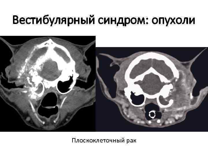 Вестибулярный синдром: опухоли Плоскоклеточный рак 