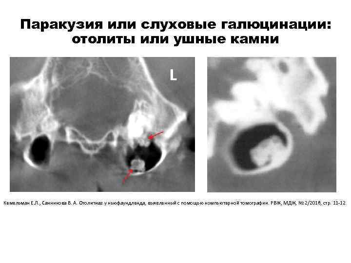 Паракузия или слуховые галюцинации: отолиты или ушные камни Кемельман Е. Л. , Санникова В.