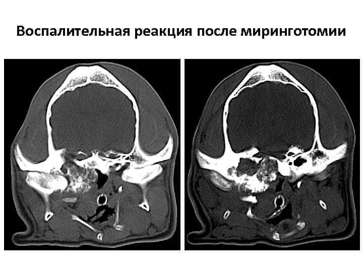 Воспалительная реакция после миринготомии 