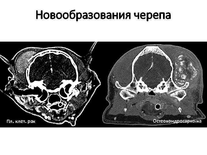 Новообразования черепа Пл. клет. рак Остеохондросаркома 