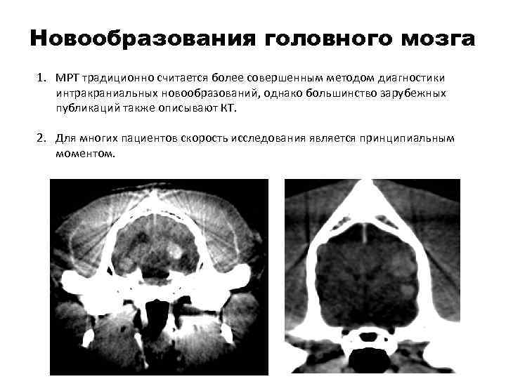 Новообразования головного мозга 1. МРТ традиционно считается более совершенным методом диагностики интракраниальных новообразований, однако