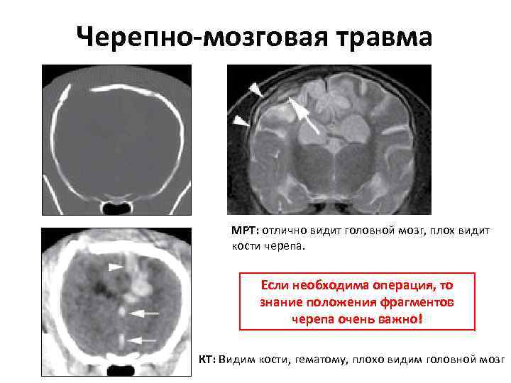 Черепно-мозговая травма МРТ: отлично видит головной мозг, плох видит кости черепа. Если необходима операция,