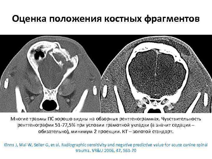 Оценка положения костных фрагментов Многие травмы ПС хорошо видны на обзорных рентгенограммах. Чувствительность рентгенографии