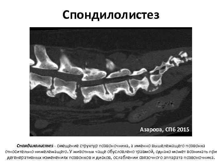 Спондилолистез Азарова, СПб 2015 Спондилолистез ‐ смещение структур позвоночника, а именно вышележащего позвонка относительно