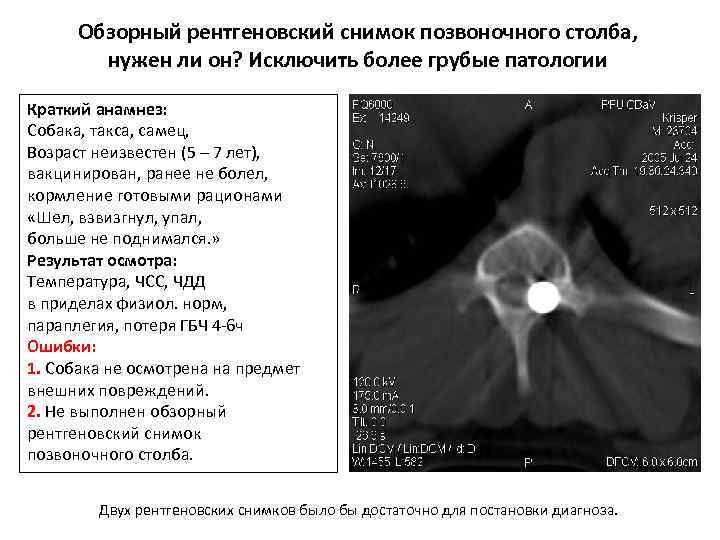 Обзорный рентгеновский снимок позвоночного столба, нужен ли он? Исключить более грубые патологии Краткий анамнез: