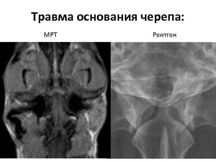 Травма основания черепа: МРТ Рентген 