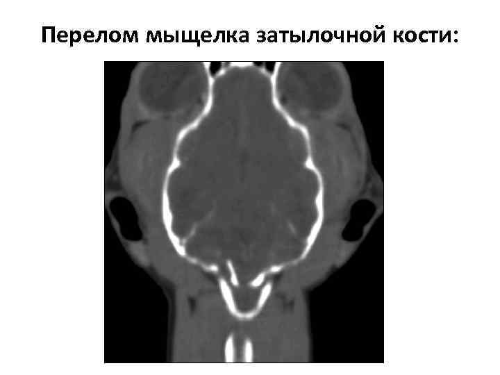 Перелом мыщелка затылочной кости: 