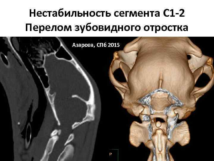 Нестабильность сегмента С 1 -2 Перелом зубовидного отростка Азарова, СПб 2015 