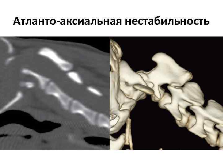 Атланто-аксиальная нестабильность 