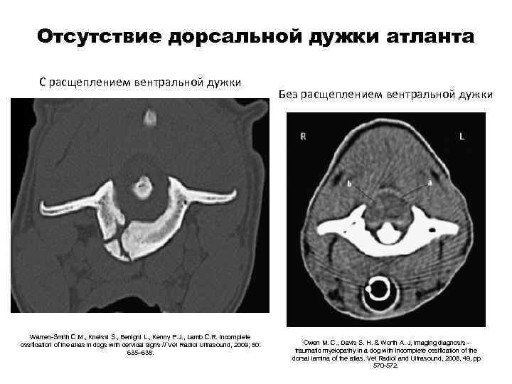 Отсутствие дорсальной дужки атланта С расщеплением вентральной дужки Warren-Smith C. M. , Kneissl S.