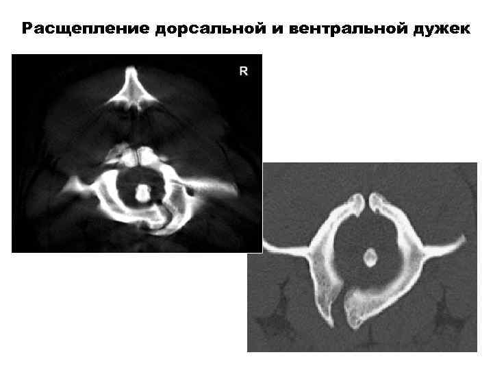 Расщепление дорсальной и вентральной дужек 