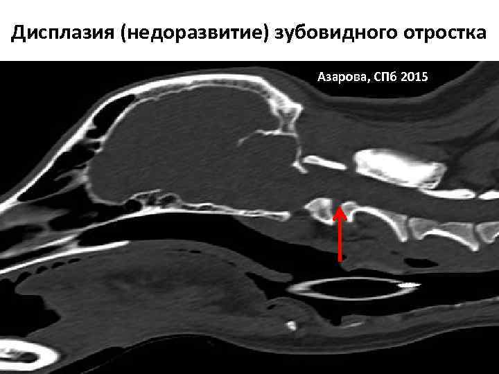 Дисплазия (недоразвитие) зубовидного отростка Азарова, СПб 2015 