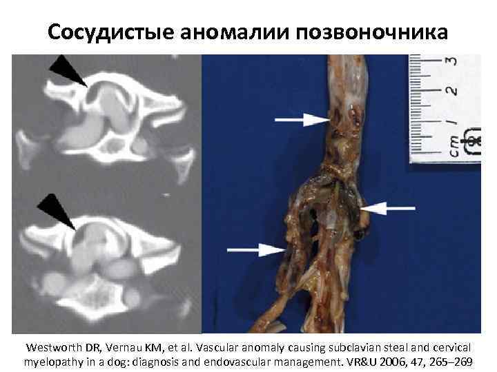 Сосудистые аномалии позвоночника Westworth DR, Vernau KM, et al. Vascular anomaly causing subclavian steal