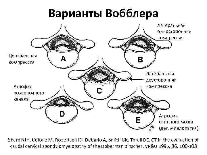 Варианты Вобблера Латеральная односторонняя компрессия Центральная компрессия Атрофия позвоночного канала Латеральная двусторонняя компрессия Атрофия