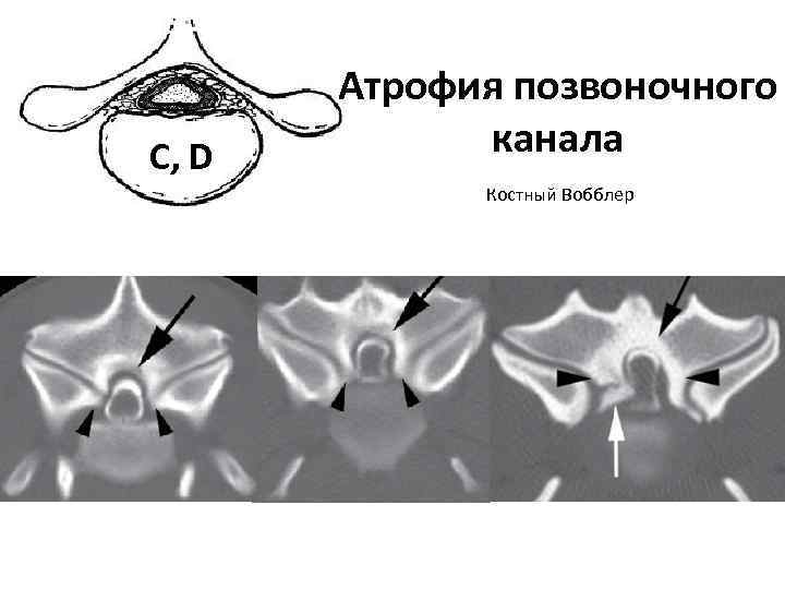 C, D Атрофия позвоночного канала Костный Вобблер 