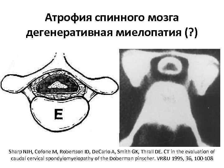 Атрофия спинного мозга дегенеративная миелопатия (? ) Sharp NJH, Cofone M, Robertson ID, De.