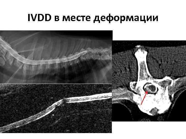 IVDD в месте деформации 