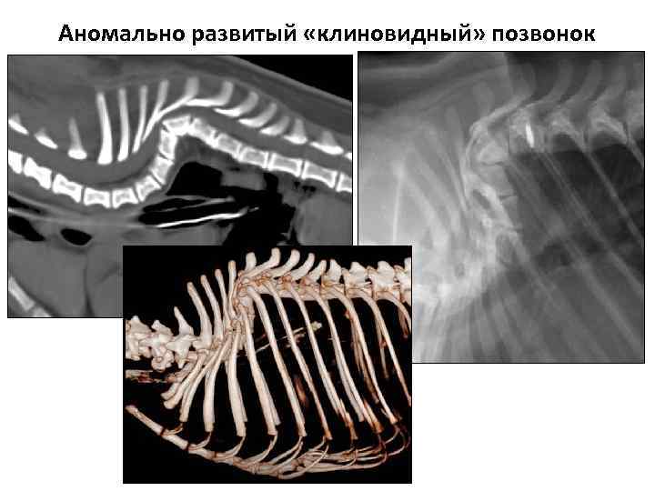 Аномально развитый «клиновидный» позвонок 