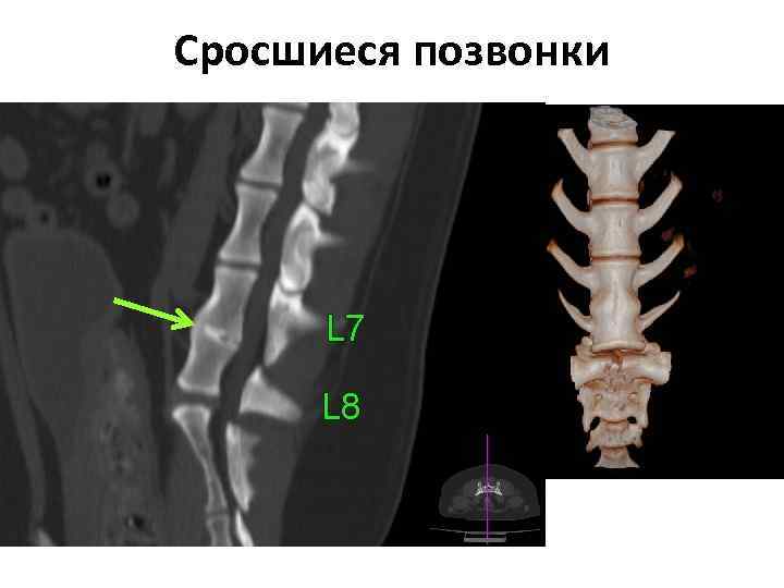 Сросшиеся позвонки 