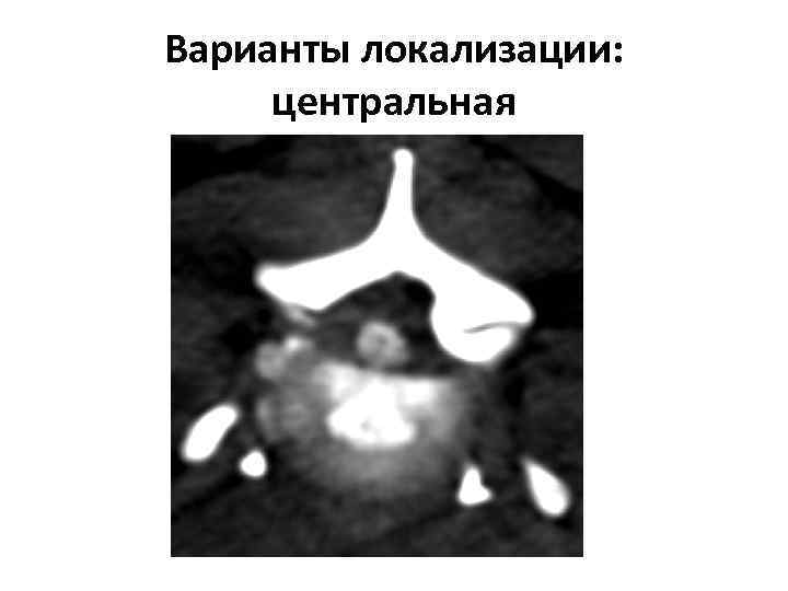 Варианты локализации: центральная 