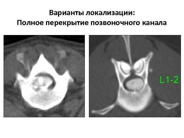 Варианты локализации: Полное перекрытие позвоночного канала 