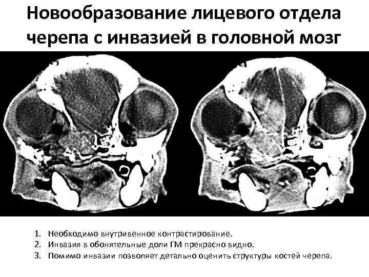 Новообразование лицевого отдела черепа с инвазией в головной мозг 1. Необходимо внутривенное контрастирование. 2.