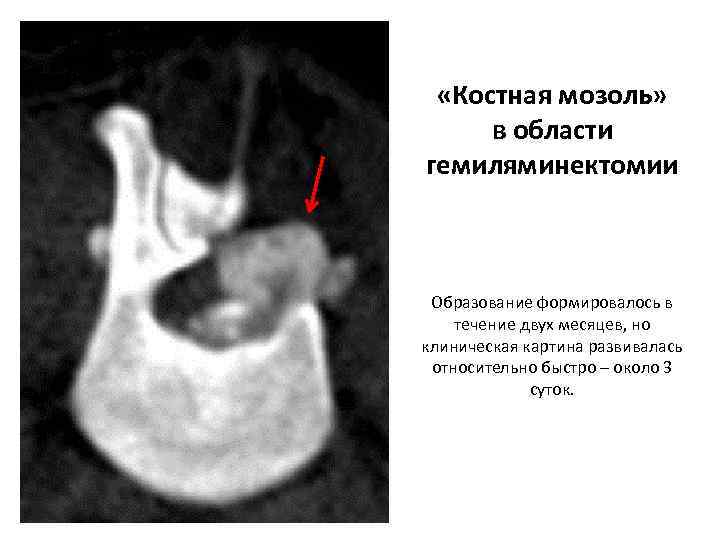  «Костная мозоль» в области гемиляминектомии Образование формировалось в течение двух месяцев, но клиническая