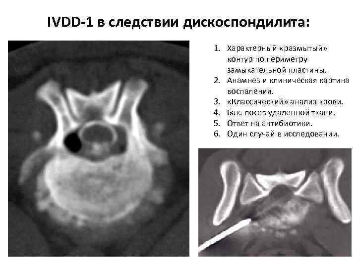 IVDD-1 в следствии дискоспондилита: 1. Характерный «размытый» контур по периметру замыкательной пластины. 2. Анамнез