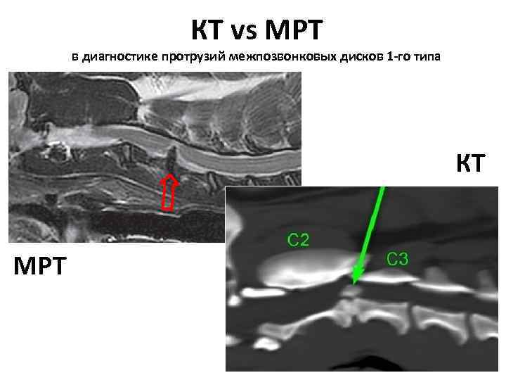 КТ vs МРТ в диагностике протрузий межпозвонковых дисков 1 -го типа КТ МРТ 