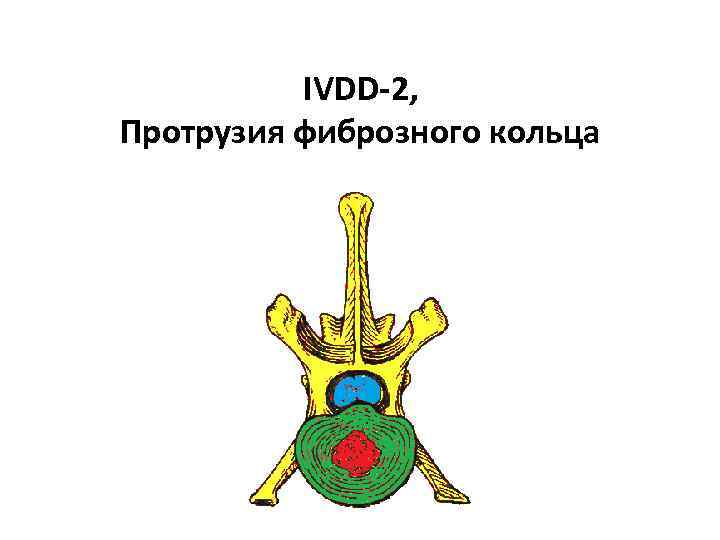 IVDD-2, Протрузия фиброзного кольца 