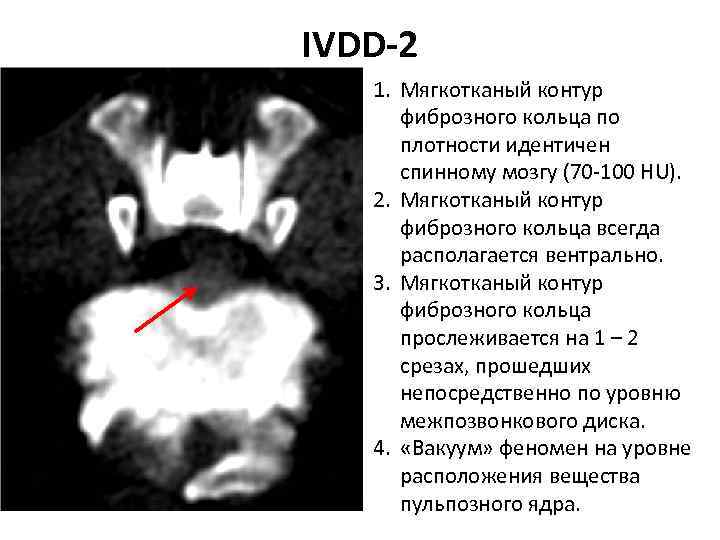 IVDD-2 1. Мягкотканый контур фиброзного кольца по плотности идентичен спинному мозгу (70‐ 100 HU).