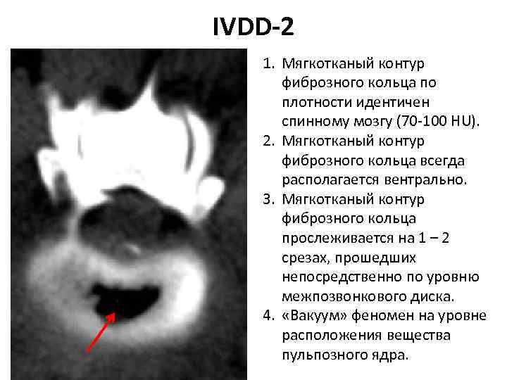 IVDD-2 1. Мягкотканый контур фиброзного кольца по плотности идентичен спинному мозгу (70‐ 100 HU).