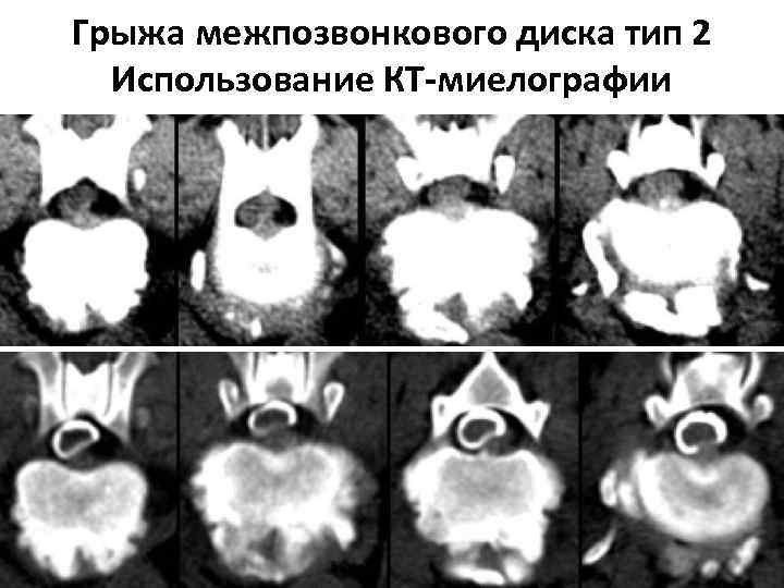 Грыжа межпозвонкового диска тип 2 Использование КТ-миелографии 