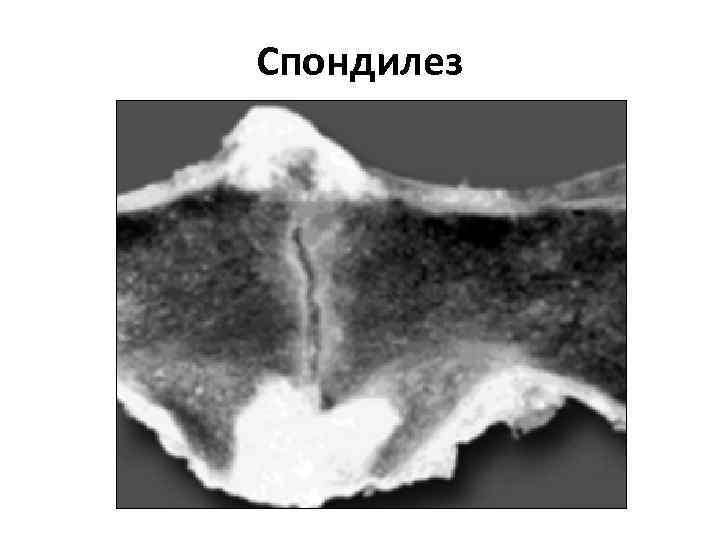 Спондилез 