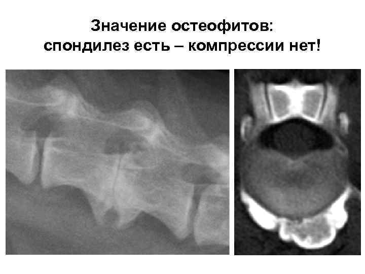 Значение остеофитов: спондилез есть – компрессии нет! 