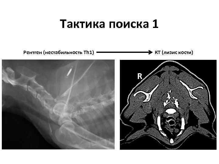 Тактика поиска 1 Рентген (нестабильность Th 1) КТ (лизис кости) 