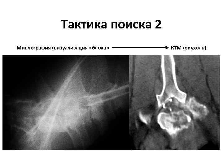 Тактика поиска 2 Миелография (визуализация «блока» КТМ (опухоль) 