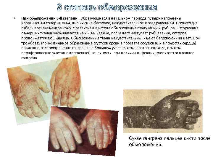 3 степень обморожения • При обморожении 3 -й степени. Образующиеся в начальном периоде пузыри