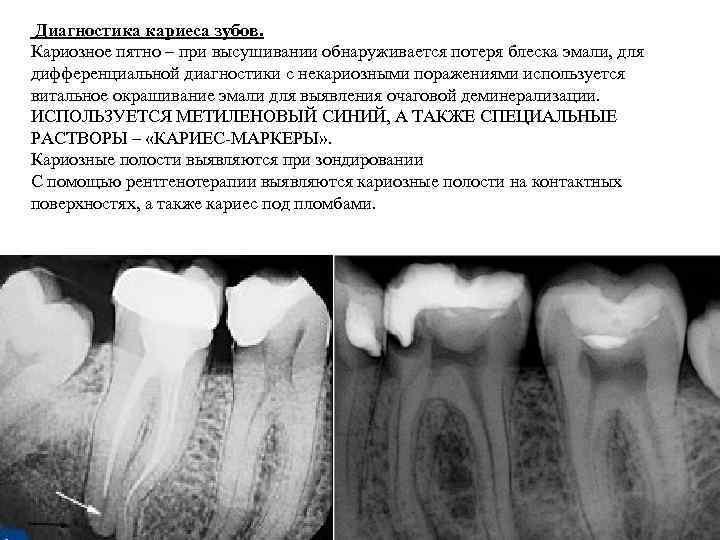  Диагностика кариеса зубов. Кариозное пятно – при высушивании обнаруживается потеря блеска эмали, для