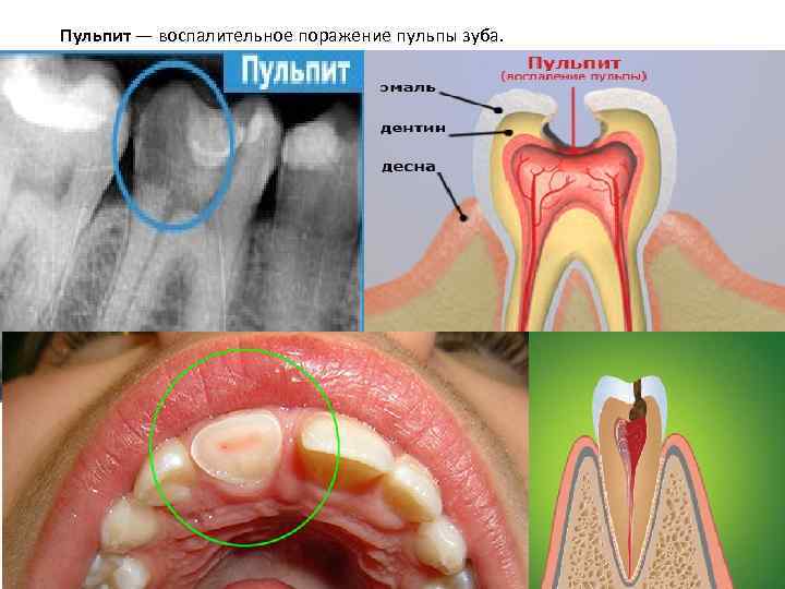 Пульпит — воспалительное поражение пульпы зуба. 