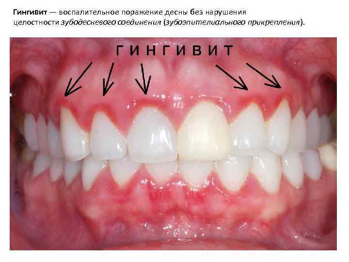 Гингивит — воспалительное поражение десны без нарушения целостности зубодесневого соединения (зубоэпителиального прикрепления). 