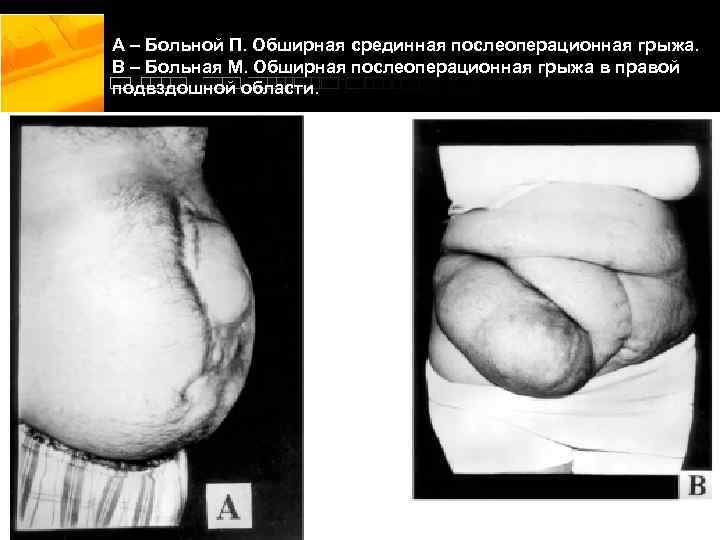 А – Больной П. Обширная срединная послеоперационная грыжа. В – Больная М. Обширная послеоперационная