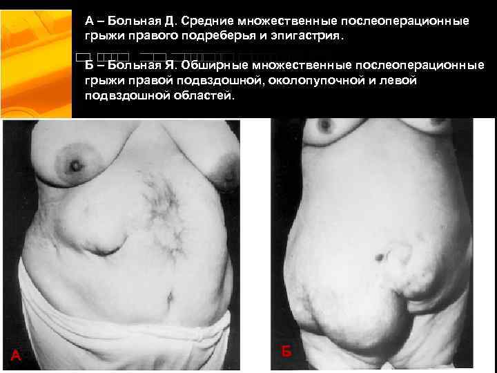 А – Больная Д. Средние множественные послеоперационные грыжи правого подреберья и эпигастрия. Б –