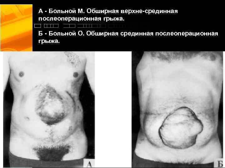 А - Больной М. Обширная верхне-срединная послеоперационная грыжа. Б - Больной О. Обширная срединная