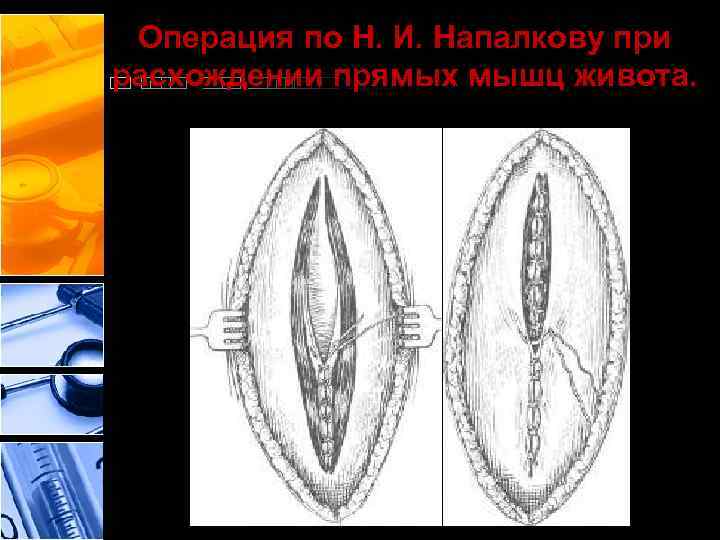 Операция по Н. И. Напалкову при расхождении прямых мышц живота. 