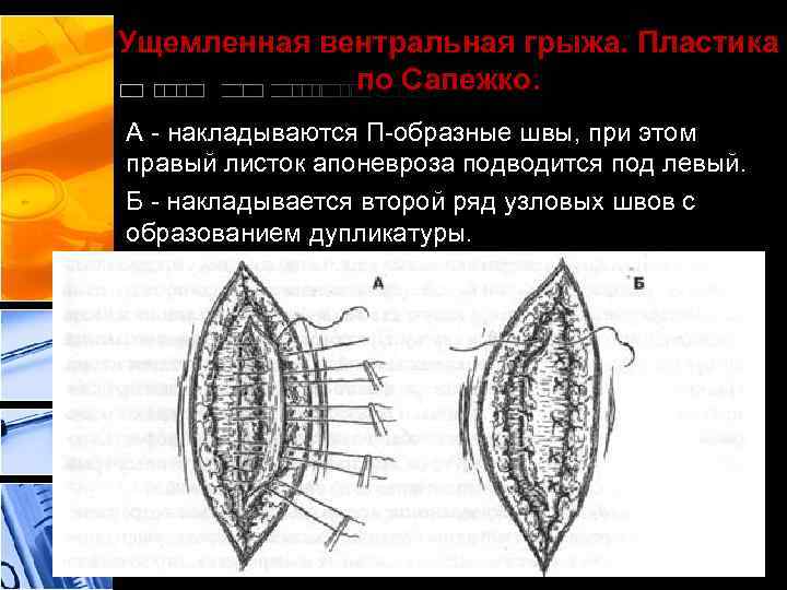 Ущемленная вентральная грыжа. Пластика по Сапежко. А - накладываются П-образные швы, при этом правый